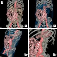 Image result for Intestinal Malrotation