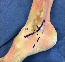 In surgery to repair the retinaculum, the surgeon first makes an incision along the back and lower edge of the fibula bone. Peroneal Tendon Repair Musculoskeletal Key