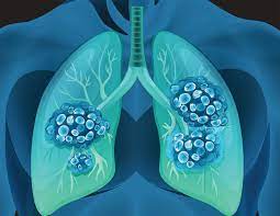 Hoarseness related to lung cancer can take place when the growth affects the nerve that controls the. Could Lung Cancer Cases Be Mistaken For Covid 19 Prova Education