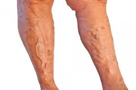 We did not find results for: Sintomas De La Trombosis Venosa Y Como Se Detecta Salud