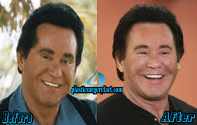 New hillary clinton plastic surgery. Wayne Newton Plastic Surgery Before And After Photos Plastic Surgery Facts