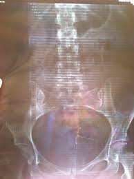 Mar 30, 2021 · if the intrauterine device has only moved slightly, you may not feel or notice anything. My Mirena Iud Led Me The Surgical Room