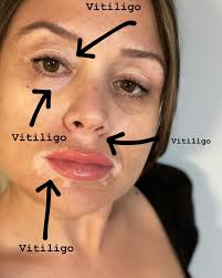 How vitiligo appears