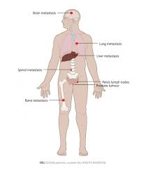 Prostate Cancer Patient Information