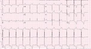 A 35 Year Old Man Presents With Non Cardiac Chest Pain And