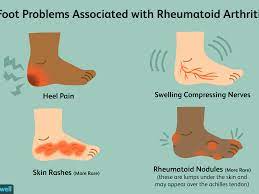 American technology, made in usa. Pain In The Feet As A Symptom Of Rheumatoid Arthritis