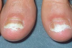 Your black toenail treatment does, of course, depend on the reason for the problem. 7 Effective Toenail Fungus Treatments Best Natural Home Remedies