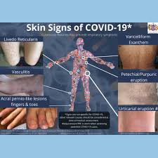 These discolored spots are caused by bleeding under the skin. Skin Signs Of Covid 19 Chroma Dermatology