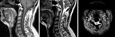 In the acute setting, there is often associated contrast enhancement. Transverse Myelitis The Spine Journal