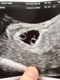 Check spelling or type a new query. Identical Twins Only 1 Heartbeat At 5 Weeks 5 Days Twin Pregnancy Forums What To Expect