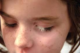 About half the people who get vitiligo are male and half are female. 922 Image 2366333 On Favim Com