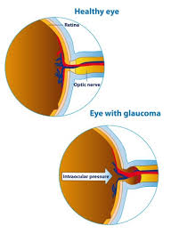 Glaucoma Test Top Eye Doctors Specialists In Nyc Optometrist Ophthalmologist