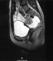 Stage iv endometriosis is the most severe stage of endometriosis and as a result, the patient feels the following symptoms: Diagnosis Of Endometriosis Kinderwunschteam Berlin