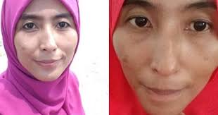 Find out what works well at hannan medispa alor setar from the people who know best. Hasil Treatment Di Hannan Medispa