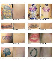 Tattoo Removal Before After Photos From Astanza