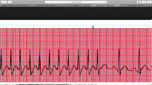 Maneuvers and drugs to slow heart rate or restore a normal rhythm. Health Heart Psvt