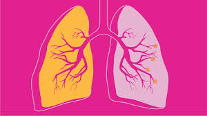 Copd Facts Statistics And You