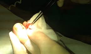 Image result for Akutní zánět nehtového lůžka