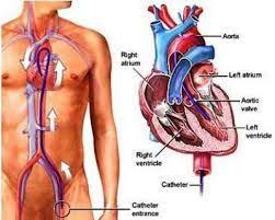 Image Result For Cardiac Ablation Surgery Ablation Surgery Heart Catheterization Cardiac Catheterization