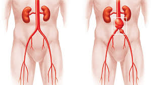 A dor é uma indicação útil, mas muitas vezes não há dor até que o aneurisma esteja grande ou em vias de se romper. Aneurisma Tipos E Tratamentos Barao Vascular Medico Vascular Em Sp