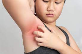 Bagaimana cara mencerahkan kulit ketiak hitam? 4 Cara Mengobati Ketiak Gatal Dengan Bahan Alami