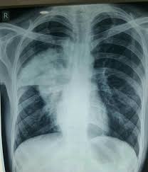Consolidation Of Middle Lobe Of The Right Lung Pneumonia Diagnostic Imaging Human Anatomy And Physiology Radiology