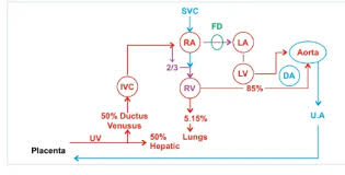 Image result for Delayed Transition from Fetal Circulation