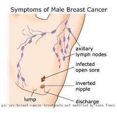 Early symptoms of cancer in men can include changes in bowel habits, unexplained weight loss, testicular changes, and difficulties urinating. Men Can Get Breast Cancer Too The Namibian