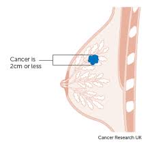 Stage 4b also means the cancer has spread outside the chest but has also been detected as more than one tumor. Tnm Staging For Breast Cancer Breast Cancer Cancer Research Uk