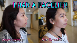 Take a look at the before and after gallery below to see the amazing results that can be achieved from the procedure. I Had A Non Surgical Face Lift Pdo Thread Lift Everything You Need To Know Kikaysikat