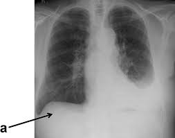 Bilateral pleural effusion toms franquet, md, phd differential diagnosis common congestive heart failure postcardiac injury syndrome infection renal disease metastatic malignant. Investigation Of A Unilateral Pleural Effusion In Adults British Thoracic Society Pleural Disease Guideline 2010 Thorax