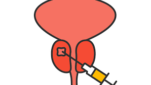 Biopsia De Prostata 10 Intrebari Si Raspunsuri Reginamaria Ro