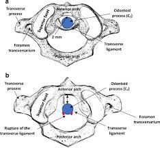 The ligaments connecting the bones are: A Schematic Representation Of The Atlanto Axial Joint In A Healthy Download Scientific Diagram