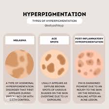 Image result for Diffuse Hyperpigmentation