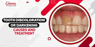Image result for Tooth Discoloration