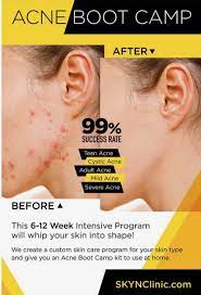Pin On Acne Boot Camp