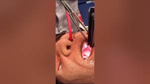 Image result for Intubation Associated Sinusitis