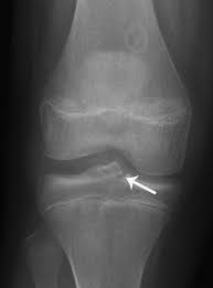 Image result for Knee XRay