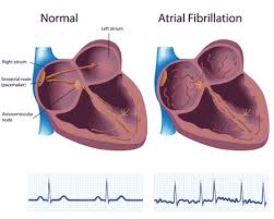 Atrial Fibrillation A Fib Learn And Practice