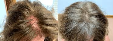 Unsurprisingly, genetics played the biggest factor in hair loss in front and on top (but not on the sides). Hair Growth Injections Tampa Growth Factors For Hair Loss