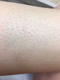 An ingrown hair is one that's grown back into your skin instead of rising up from it. This Happened After Epilating My Legs I M Covered In Bumps And Although I Had Let My Hair Grow Out For 5 Days There S Really Tiny Hairs Popping Up A Few Days After
