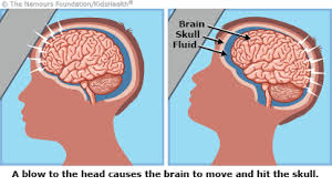 Symptoms can last for days, weeks or even longer. A To Z Concussion For Parents Nemours