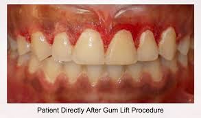 A receding gum line can be a consequence of such a thing by a untreated gum disease into gum infection or a personal injury into the gum itself. Gum Lift In Ny Nj Ct Complete Guide
