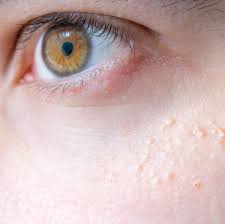 Image result for milium cyst on eyelid