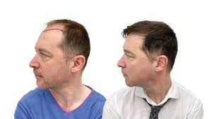 Resultater før og etter en hårtransplantasjon