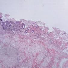 Image result for Neutropenic Colitis