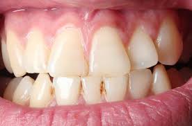 How often should you brush your teeth with braces? Preventing Tartar Buildup On Your Teeth Dr Ernie Soto