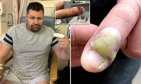 Sepsis is the body's extreme response to an infection. Serial Nail Biter 48 Is Left Fighting For His Life In Hospital After Getting Blood Poisoning Daily Mail Online