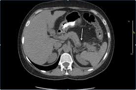 Recessed lighting installation necrotizing pancreatitis prognosis. Cureus Drug Induced Acute Pancreatitis After Long Term Sulfasalazine Therapy
