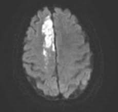 Posterior circulation stroke can cause unilateral or bilateral deficits and is more likely to affect consciousness, especially when the basilar artery is involved. Ischemic Stroke Mechanisms Evaluation And Treatment Clinical Gate